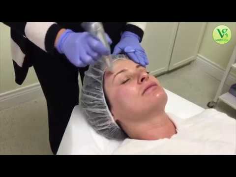 MICRONEEDLING (Vital collagen induction therapy) demonstration
