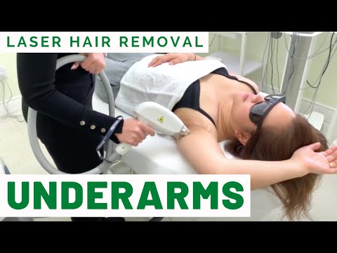 Laser Hair Removal for Underarms. Soprano XL