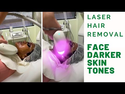 Laser Hair Removal for Face Area | Darker Skin Tones. Pain-free
