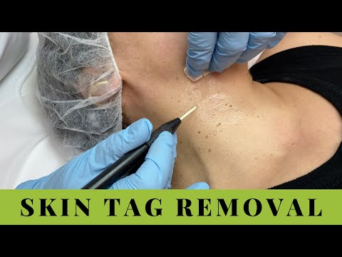 Skin Tags Removal on Neck and Underarms. Quick, easy, no pain.