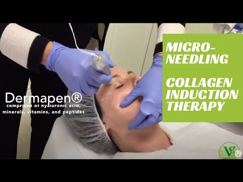 Microneedling Dermapen face treatment  (collagen induction therapy) to boost collagen production