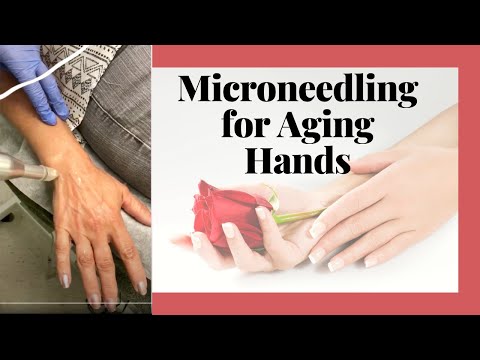 Microneedling for Aging Hands to reduce, aging, fine lines, wrinkles, sun spots