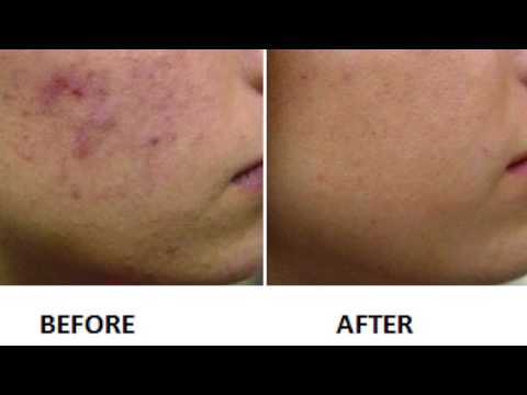 ACNE TREATMENT WITH INNO-SYSTEM® PURIFIER KIT MESOTHERAPY