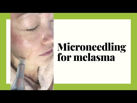 Microneedling for Melasma,  Skin pigmentation,  Age Spots, Sun Spots