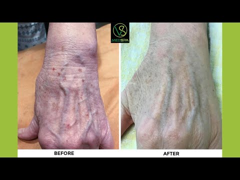 How To Get Rid Of Hyperpigmentation on hands with IPL photofacial | Sun damage On Hands | Age spots