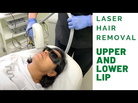 Laser Hair Removal for Upper and Lower Lip. Facial hair removal