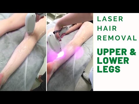 Laser Hair Removal for Upper and Lower Legs for women and men in Toronto.