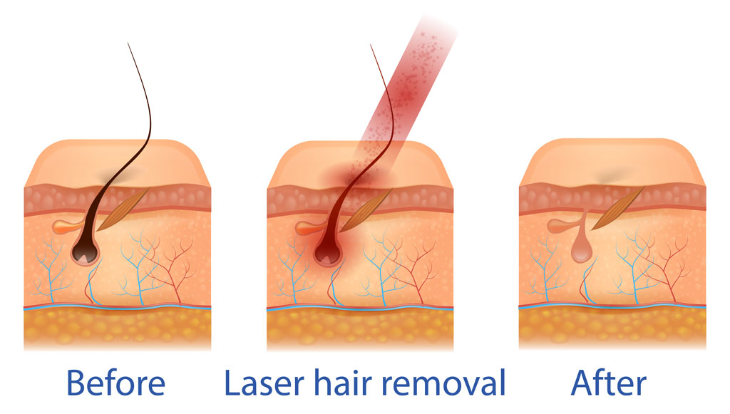 Cordelia laten vallen masker Brazilian Laser Hair Removal for Men - VS MedSpa Laser Clinic
