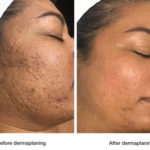 before-and-after-dermaplaning-2