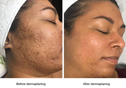 before-and-after-dermaplaning