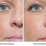 before-and-after-dermaplaning2
