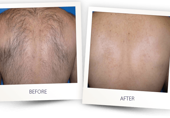 laser hair removal back before and after