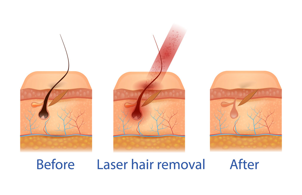 How does laser hair removal work