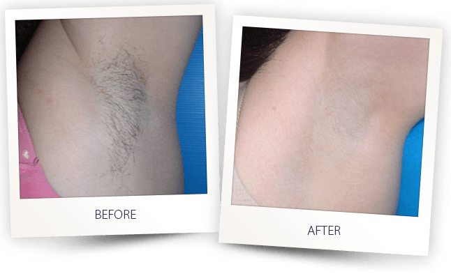 laser hair removal armpit before after