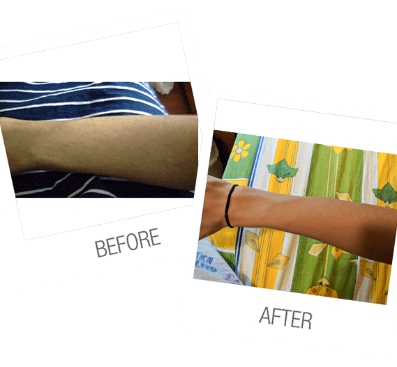 laser hair removal arms before and after