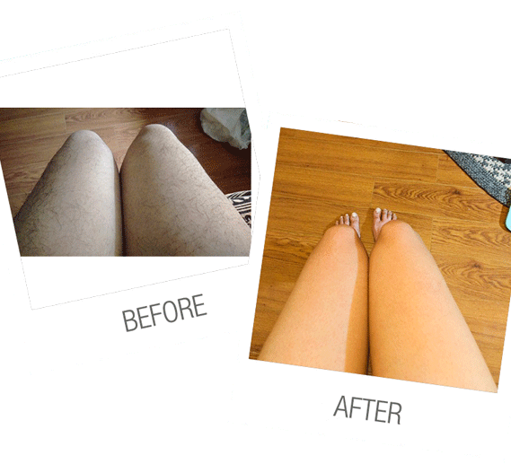laser hair removal legs before and after