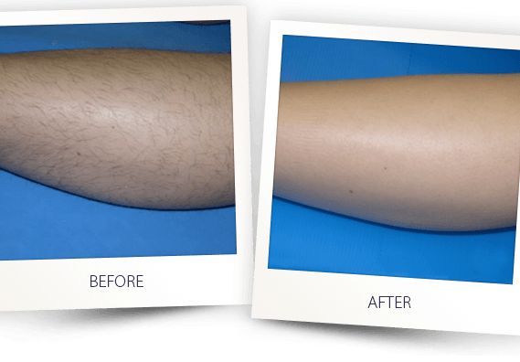 laser hair removal leg before after