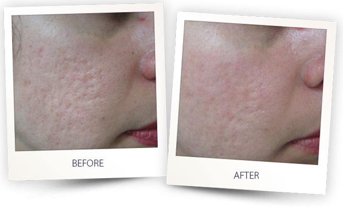 acne scar removal