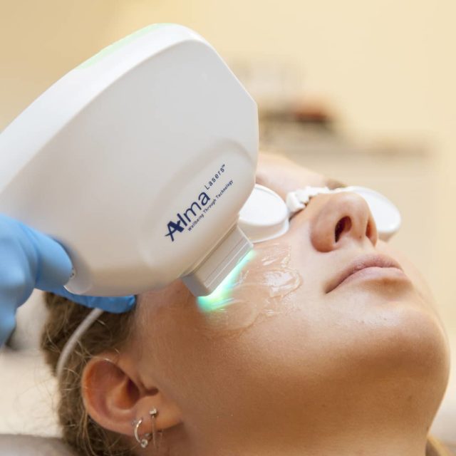 IPL Photofacial Skin Rejuvenation Toronto VS MedSpa