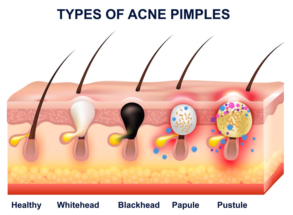 TYPES OF ACNE