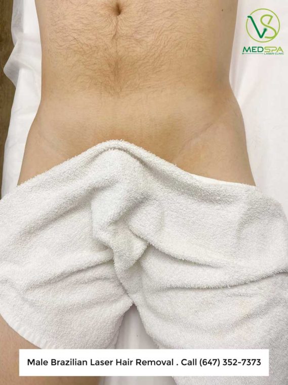 Pubic hair male brazilian laser hair removal before and after