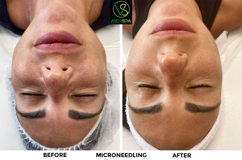 microneedling facial before and after