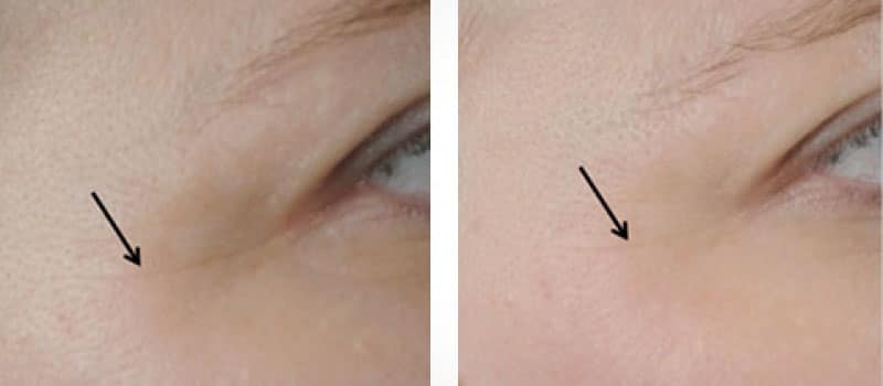 oxygeneo before and after fine lines
