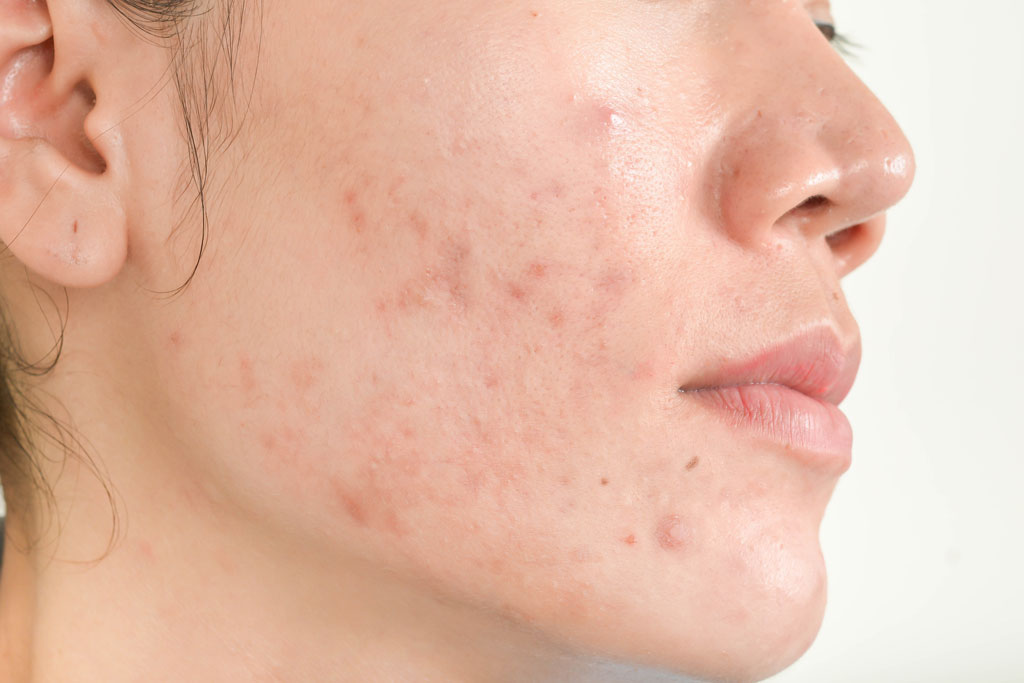 acne scar face