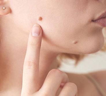 skin tag and mole removal