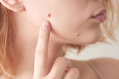 skin tag and mole removal