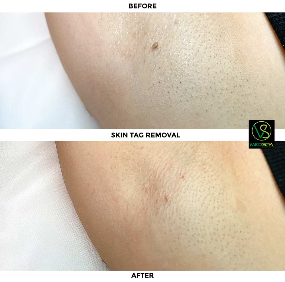 skin tag removal underarms