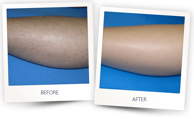 LASER HAIR REMOVAL LEG BEFORE AFTER