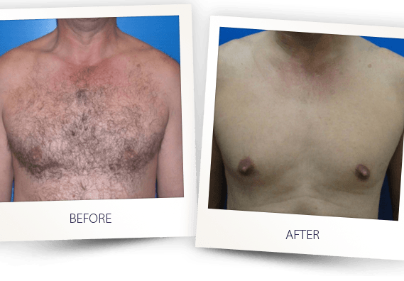 HAIR REMOVAL MEN CHEST BEFORE AFTER