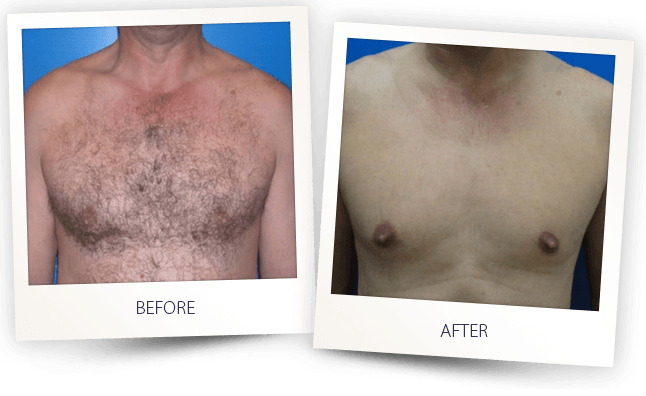 LASER HAIR REMOVAL MEN CHEST BEFORE AFTER