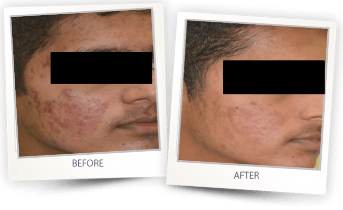 acne treatment on face