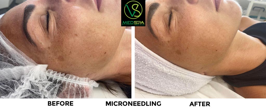 microneedling facial before and after