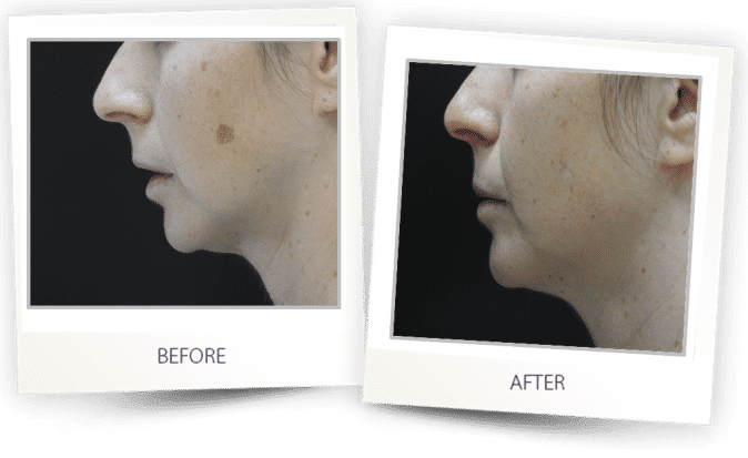 pigmented lesions treatment on face