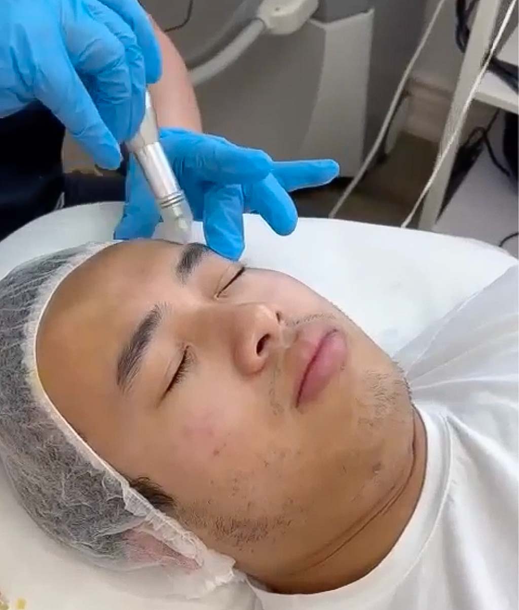 Microneedling facial for men