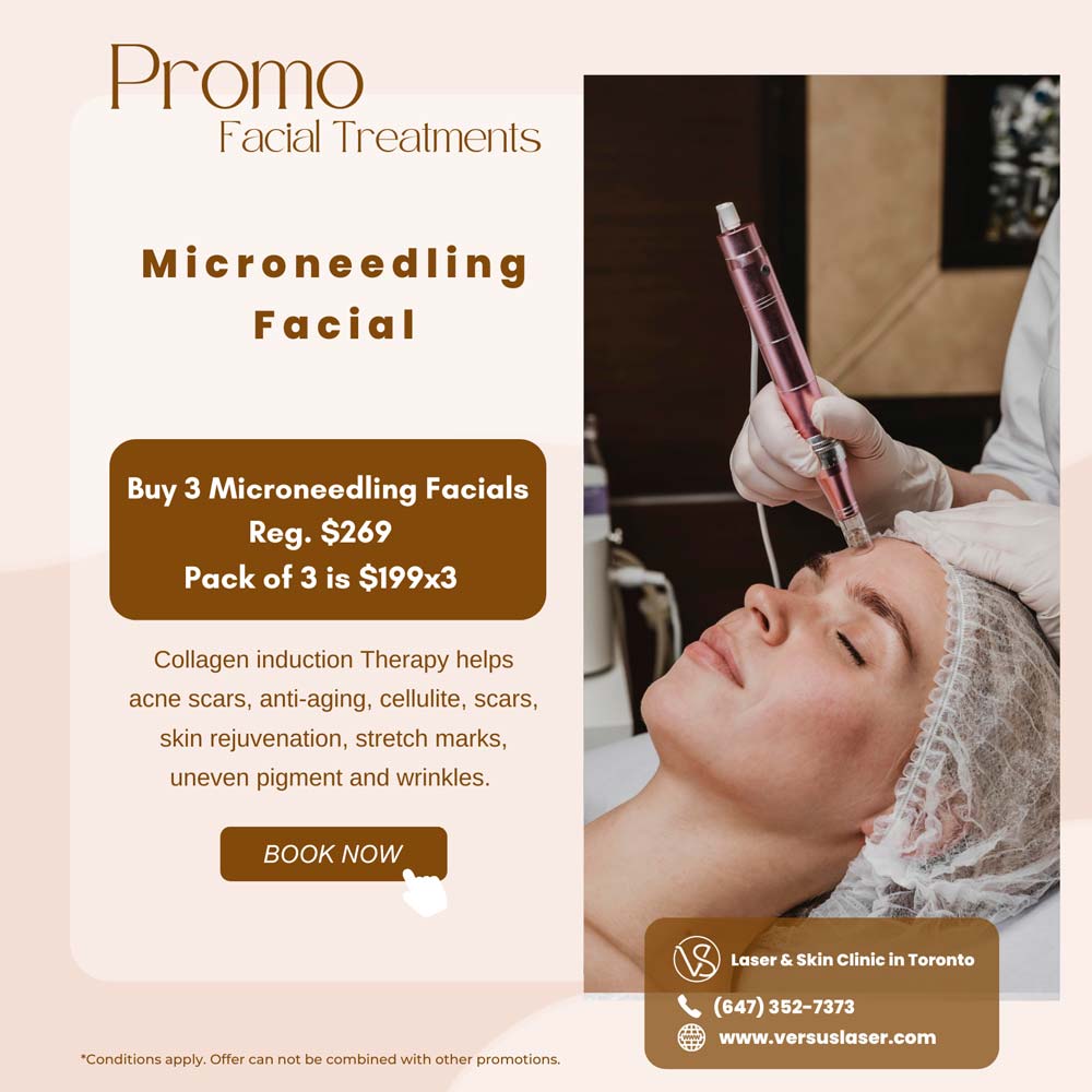 Microneedling facial special deal