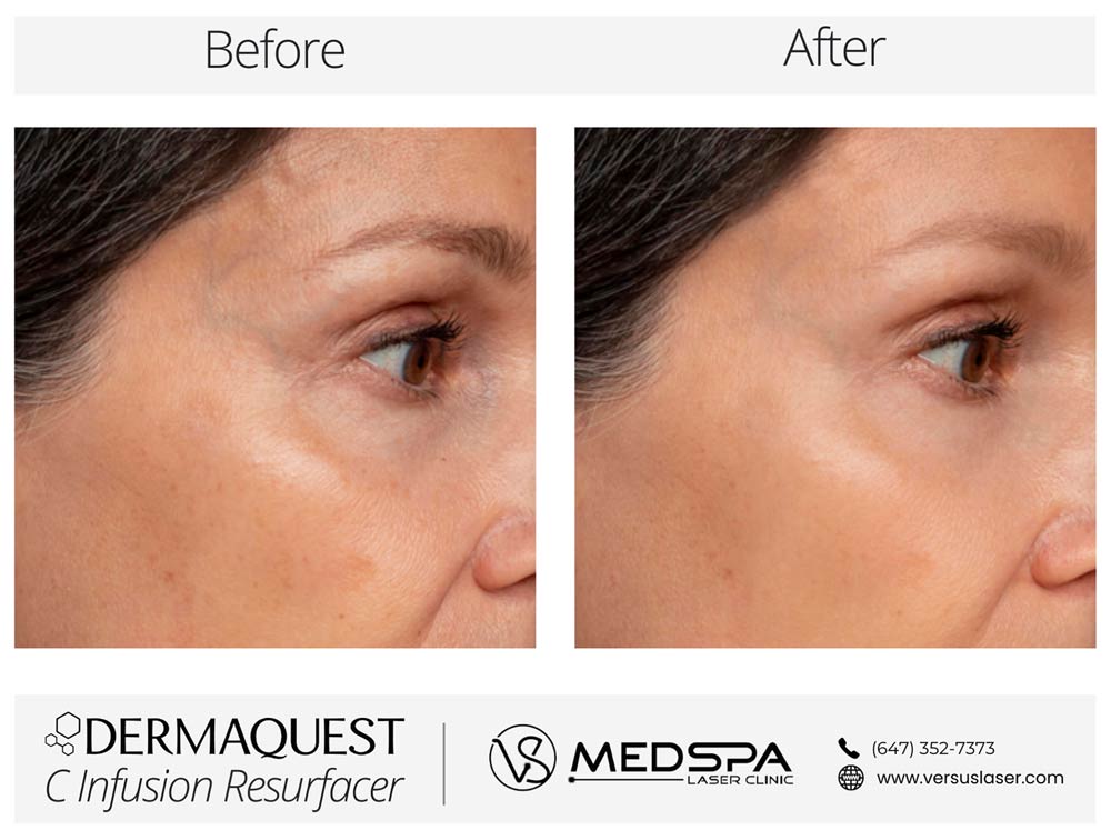DermaQuest C Infusion Resurfacer Before and After