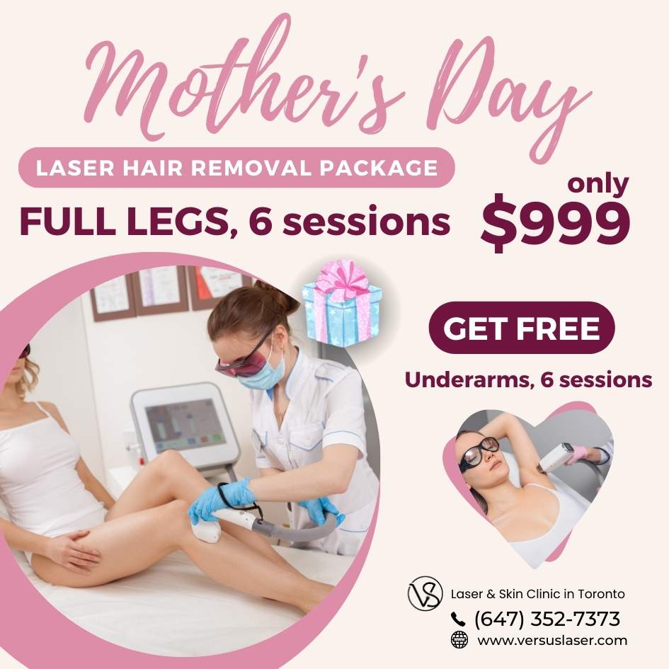 Full Legs Laser Hair Removal Package Mother's Day