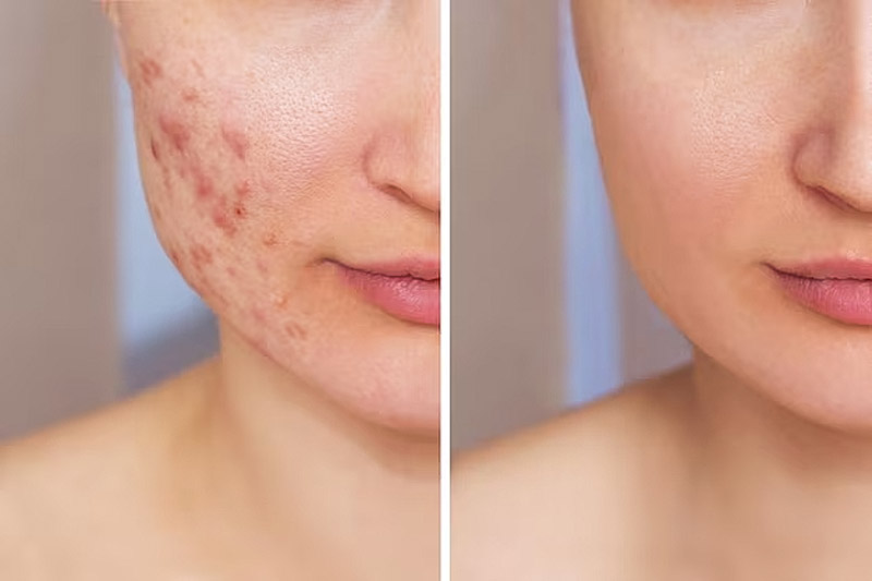 yellow peel on face before & after acne