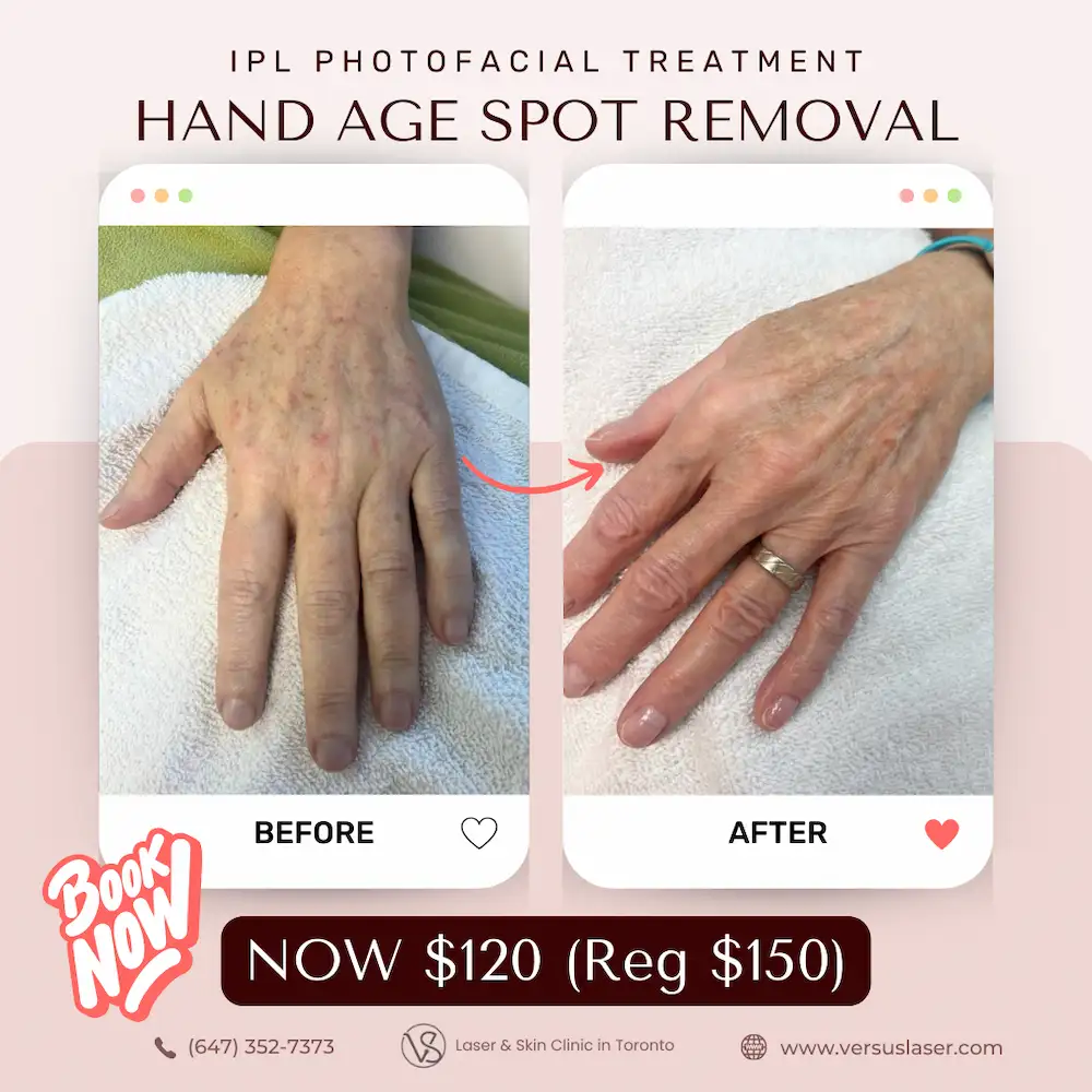 Hand Age Spot Removal IPL photo facial Toronto